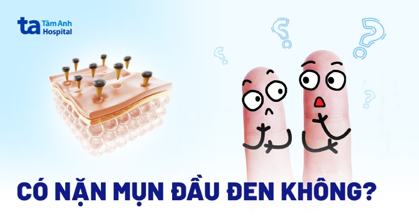 có nên nặn mụn đầu đen không