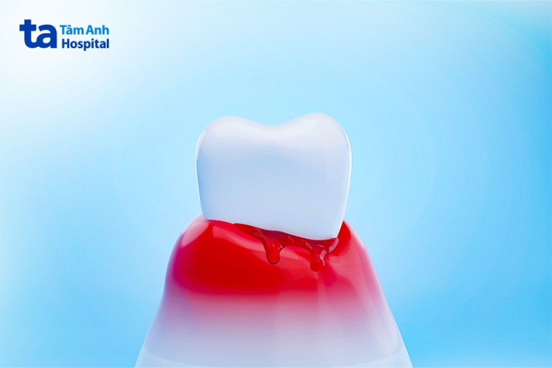 dấu hiệu viêm lợi