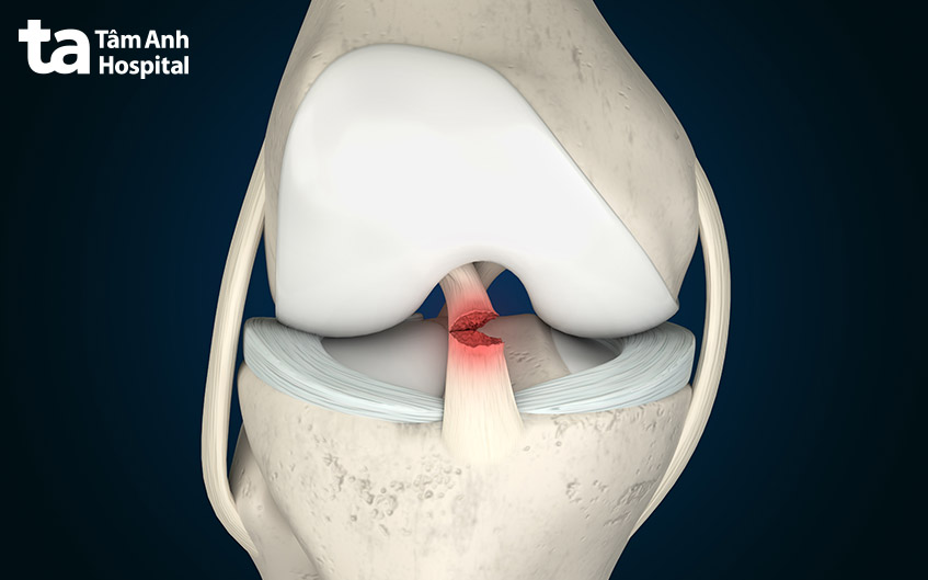 dây chằng acl bị đứt