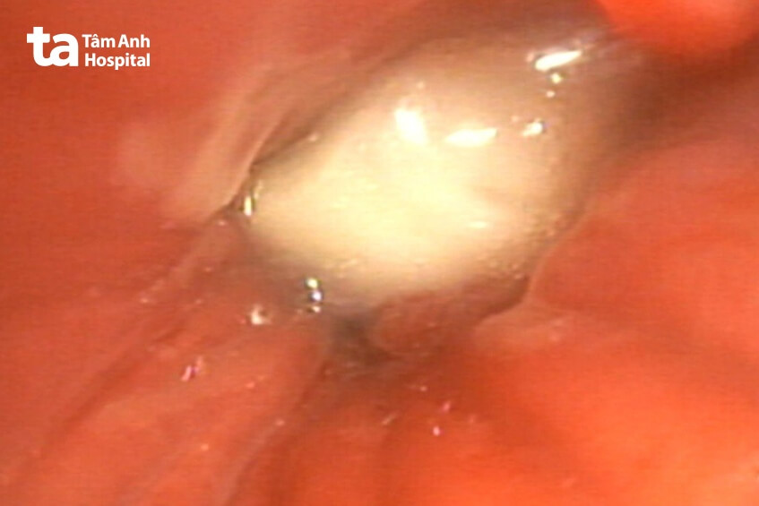 dị vật mảnh hạt điều nằm sâu trong phổi