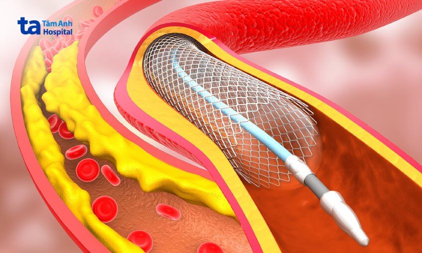 điều trị thiếu máu não ở người già