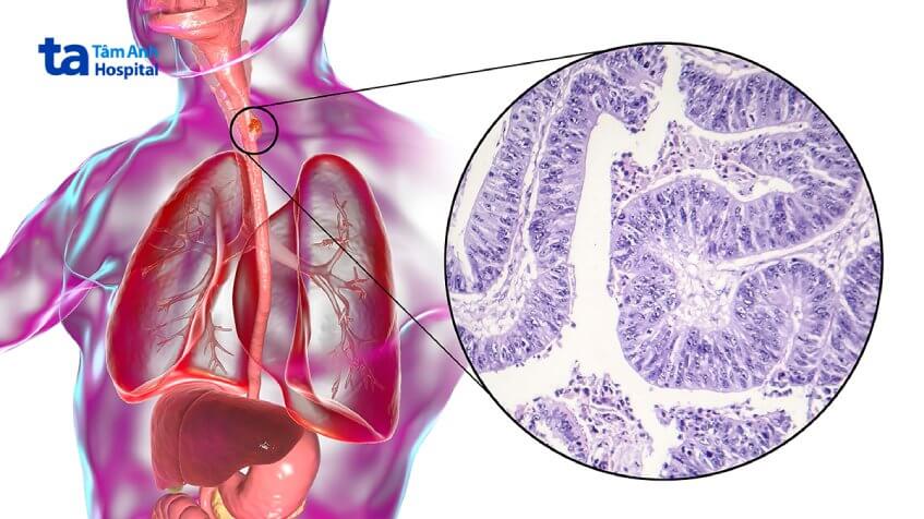 điều trị ung thư thực quản giai đoạn 0