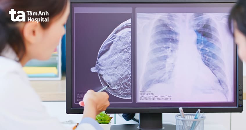 điều trị ung thư vú ở người trẻ tuổi