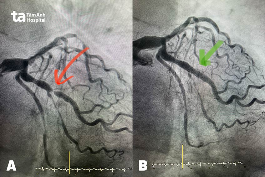 Động mạch liên thất trước của bệnh nhân hẹp 99% (hình A) và sau khi được đặt stent tái thông (hình B)