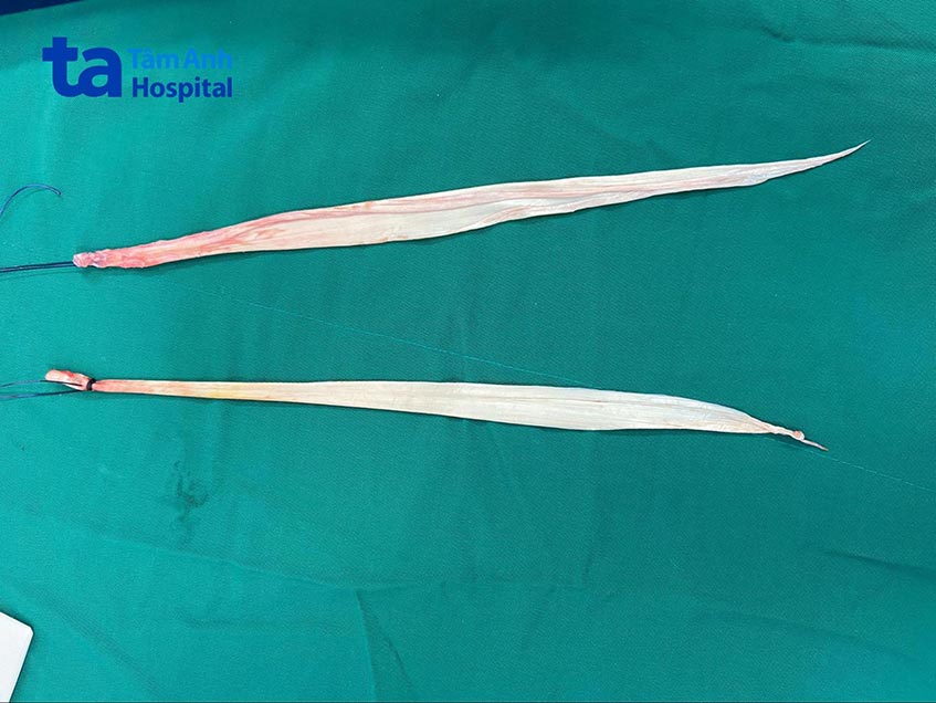 gân tứ đầu đùi của bệnh nhân