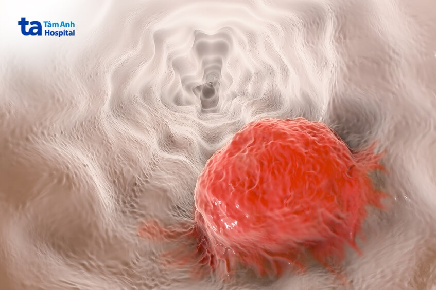 giai đoạn 1 ung thư thực quản