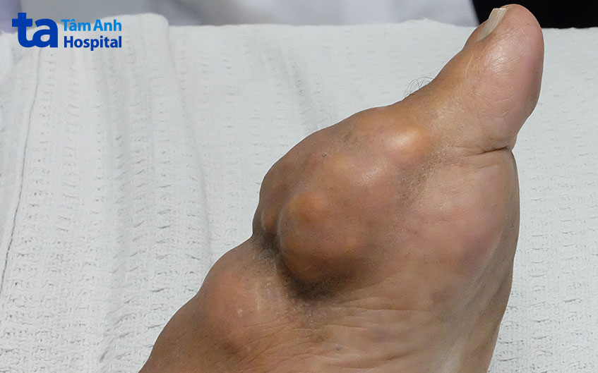 gút mạn tính gây ra biến chứng hạt tophi