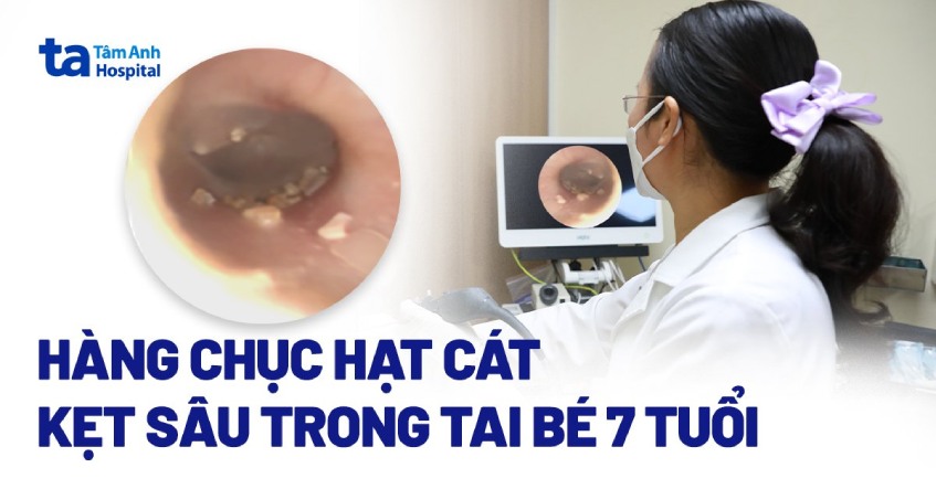 hạt cát kẹt sâu trong tai bé