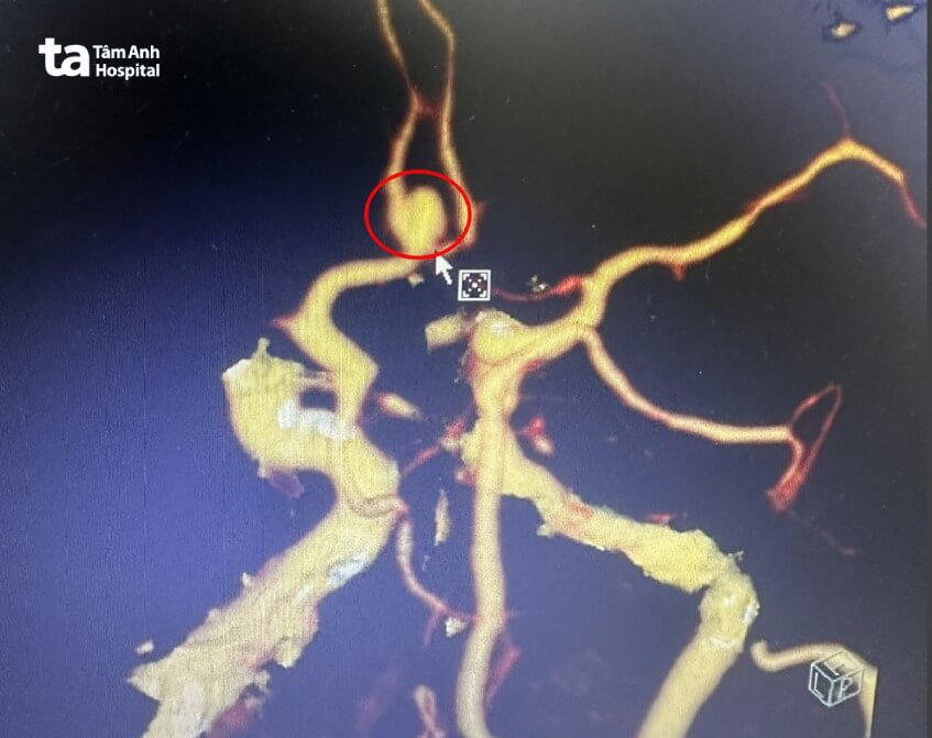 hình ảnh chẩn đoán cụ bà bị đột quỵ nửa đêm do vỡ mạch máu não