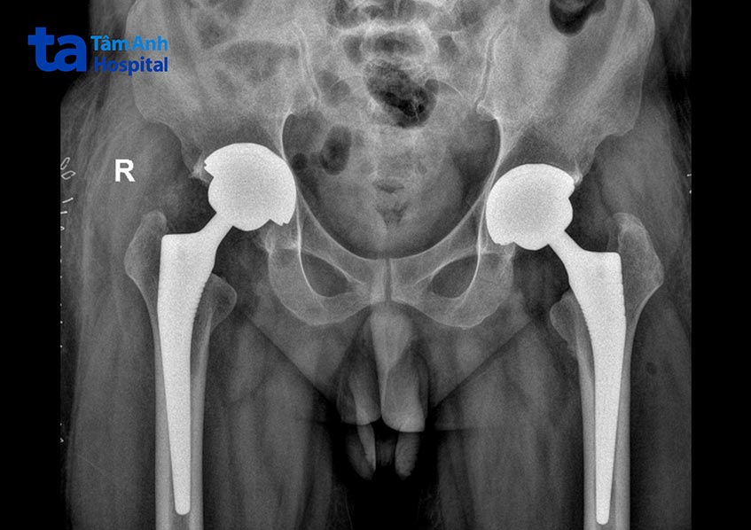 hình ảnh x quang khớp háng nhân tạo của bệnh nhân