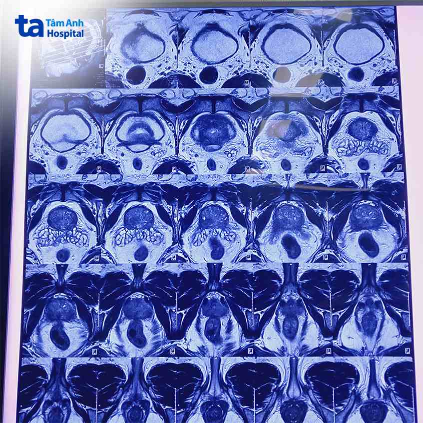 hình mri tuyến tiền liệt