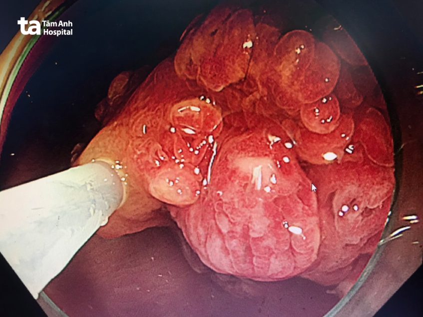 Khối polyp hình chùm nho mọc trong ruột già bệnh nhi