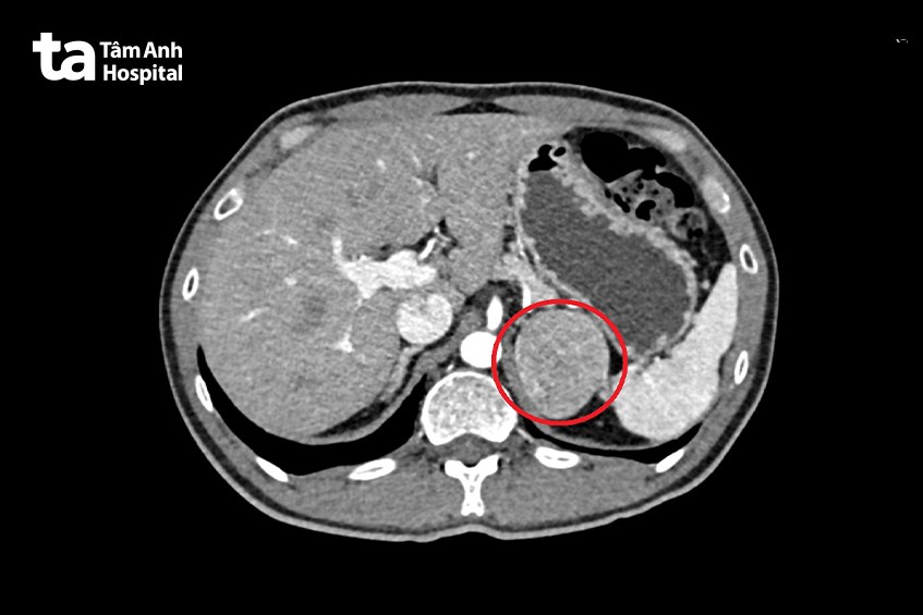 khối u tủy thượng thận