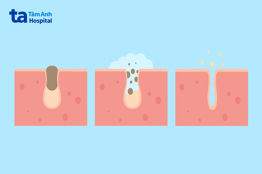 Dùng sữa rửa mặt có chứa axit salicylic đều đặn 2 lần/ngày để lỗ chân lông sạch sâu và ngăn nổi mụn đầu đen ở cằm.