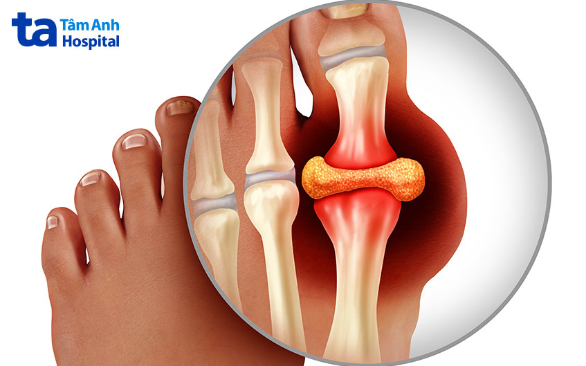 lắng đọng urat trong các khớp