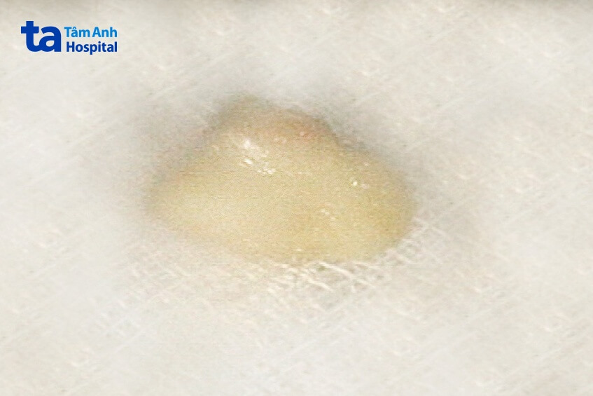 mảnh hạt điều nằm sâu trong phổi đã gắp ra