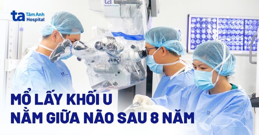 mổ lấy khối u nằm giữa não sau 8 năm