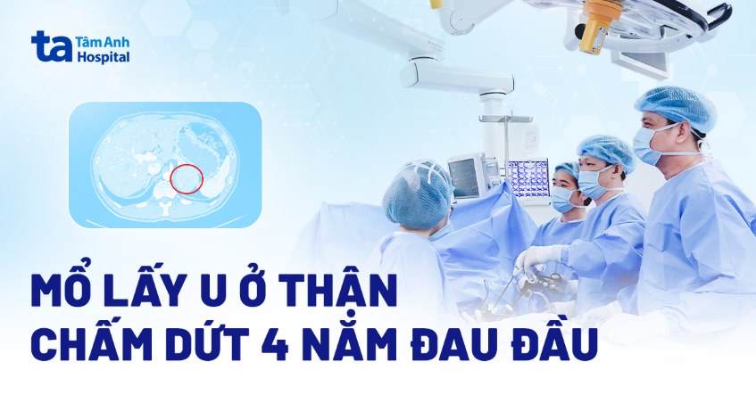 mổ lấy u ở thận chấm dứt 4 năm đau đầu