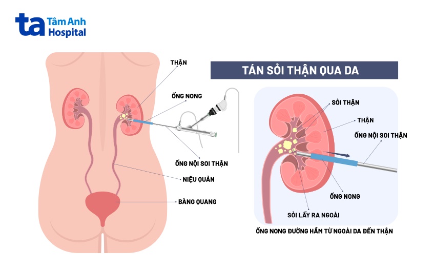 mô phỏng phương pháp tán sỏi
