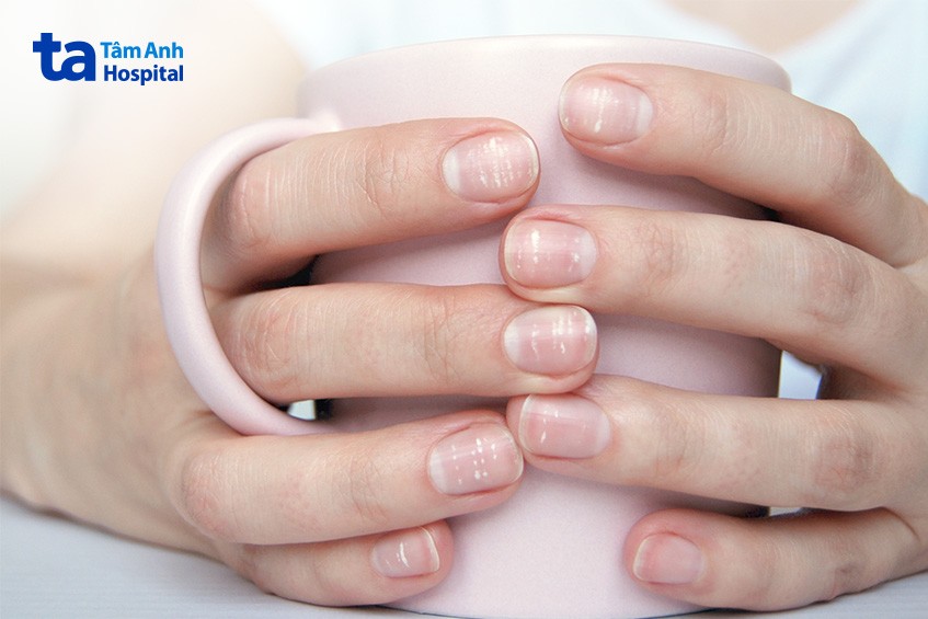 Móng tay giòn, dễ gãy có thể cảnh báo dấu hiệu tụt canxi