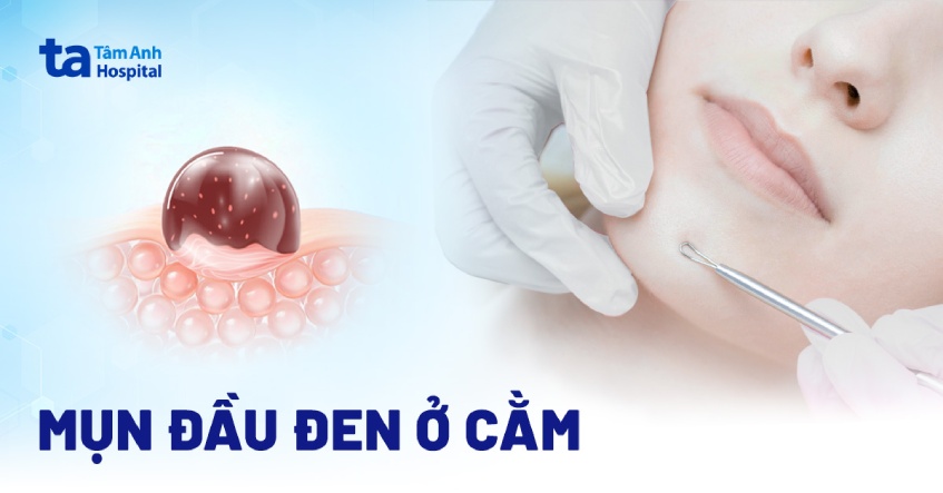 Mụn đầu đen ở cằm: Nguyên nhân, dấu hiệu và cách phòng ngừa