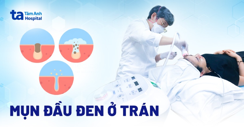 Mụn đầu đen ở trán: Nguyên nhân, dấu hiệu và cách trị dứt điểm