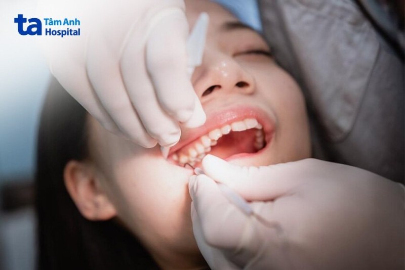 Nên nhổ răng vào lúc nào là tốt nhất?