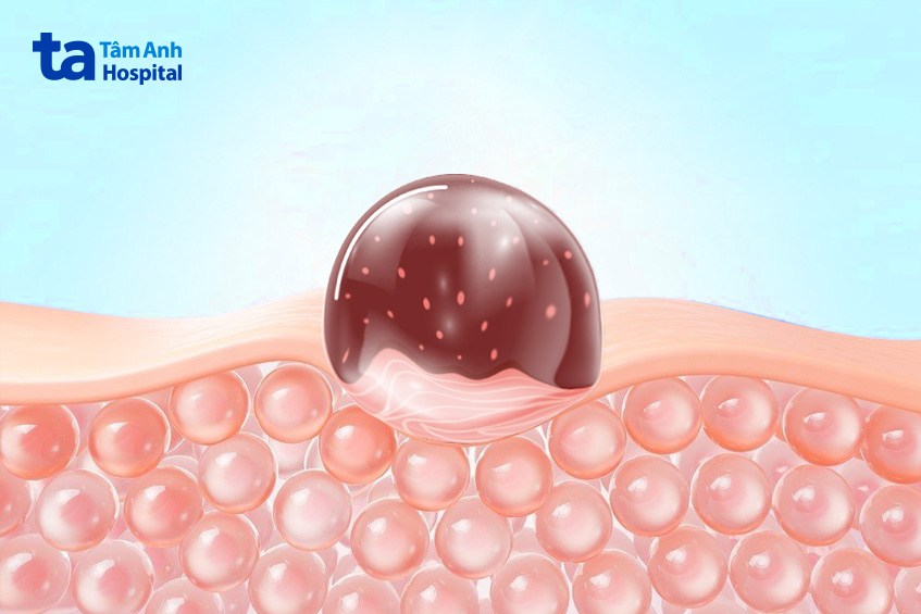 Mụn đầu đen ở cằm là nốt mô, nổi trên bề mặt da, có đầu hở, màu sẫm.