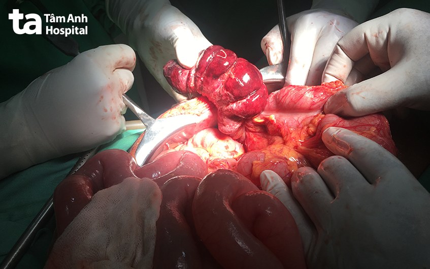 Phẫu thuật điều trị lồng ruột cấp