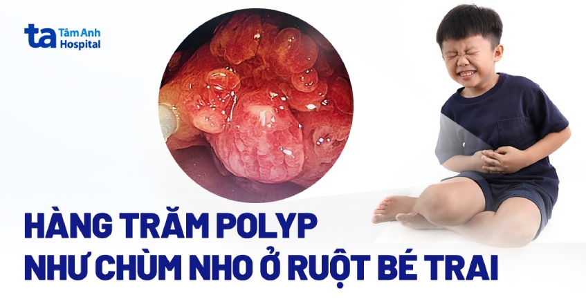 Hàng trăm polyp tựa chùm nho bám ở đại tràng bé 10 tuổi