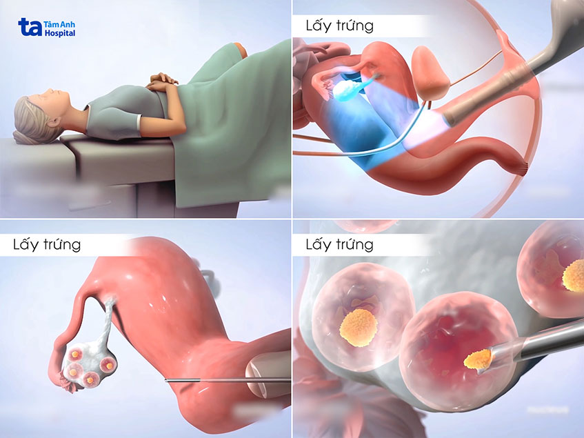 quy trình chọc hút noãn