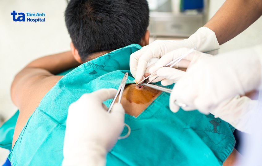 quy trình sinh thiết hạch