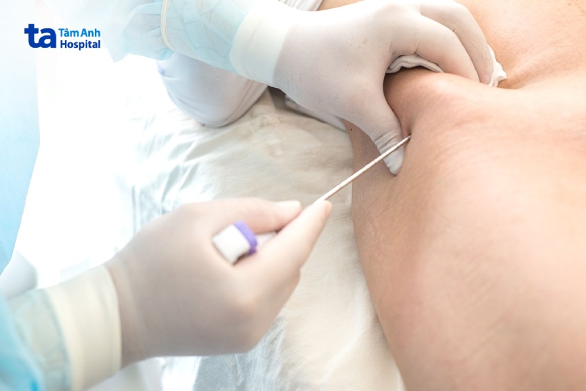 quy trình sinh thiết tủy xương