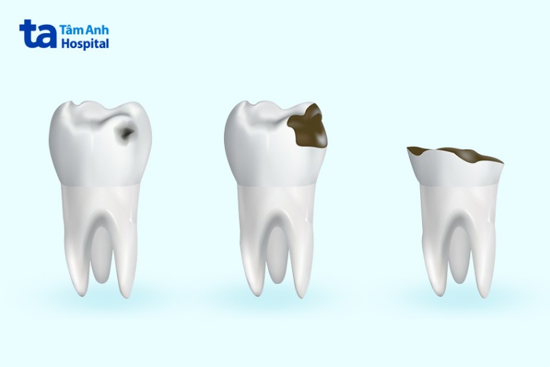 Dấu hiệu sâu răng