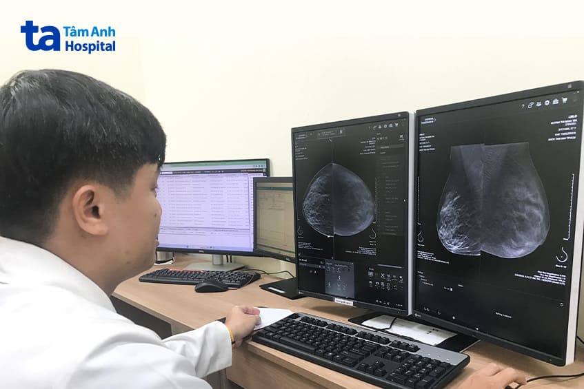 sàng lọc ung thư vú ở người trẻ