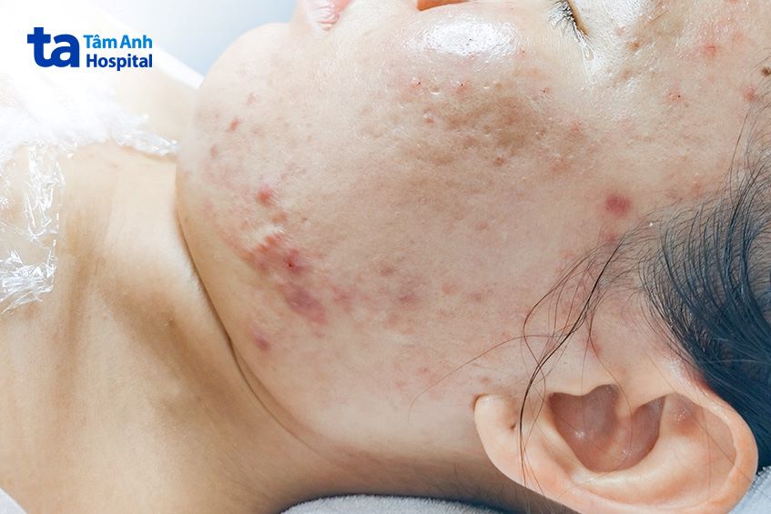 sẹo do nặn mụn