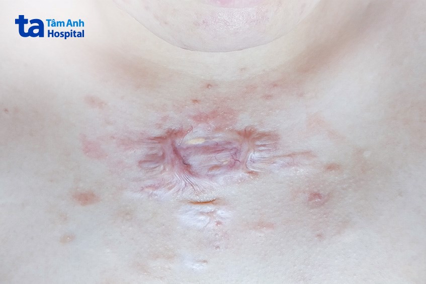 sẹo do phẫu thuật u nang tuyến bã