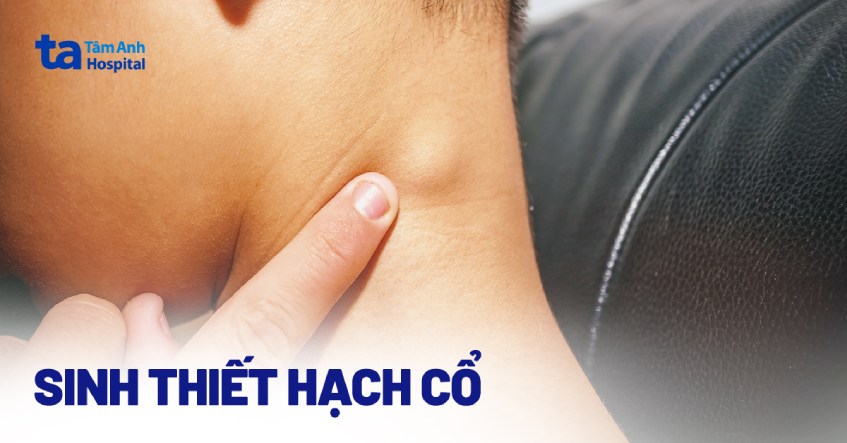sinh thiết hạch ở cổ