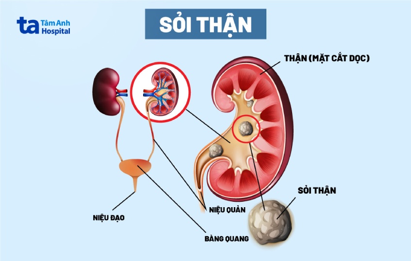 Sỏi thận là bệnh gì