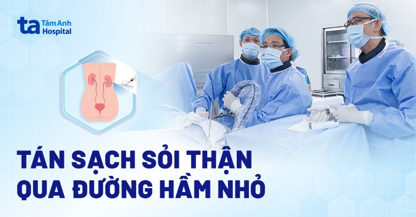 tán sạch sỏi thận qua đường hầm nhỏ