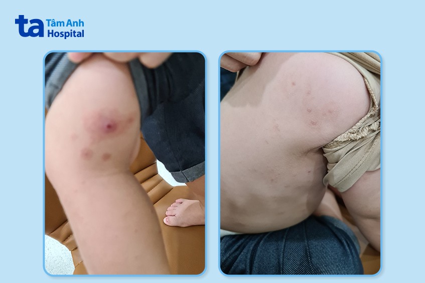 Tổn thương do viêm da cơ địa trên da bé N. đã mờ đi sau chưa đầy 1 tuần điều trị