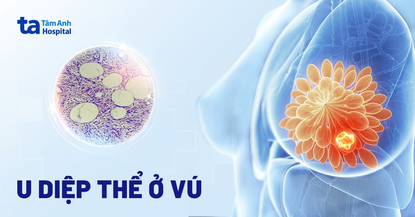 U diệp thể tuyến vú