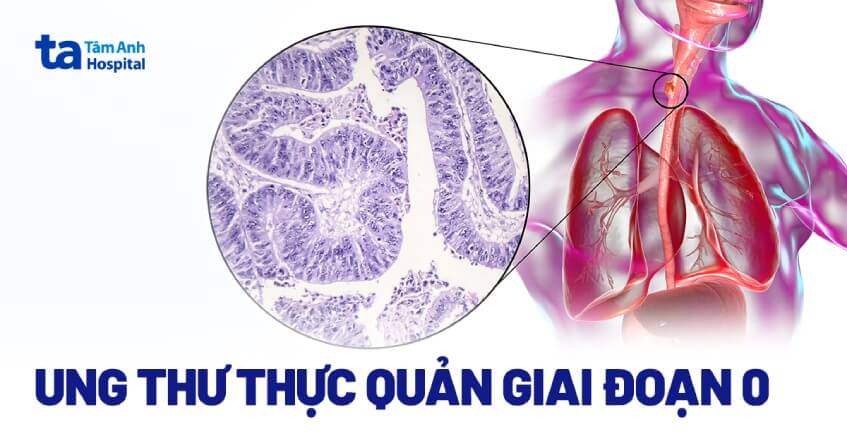Ung thư thực quản giai đoạn 0: Cẩn thận giai đoạn tiền ung thư