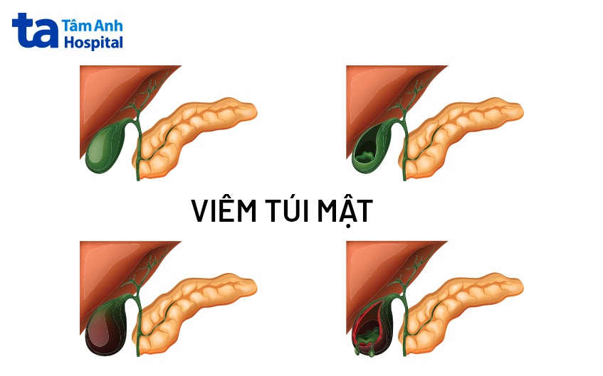 viêm túi mật mãn tính