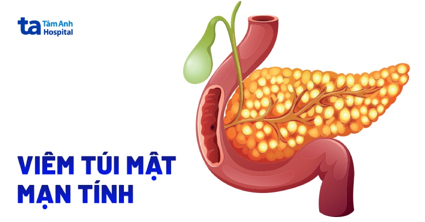 viêm túi mật mạn tính