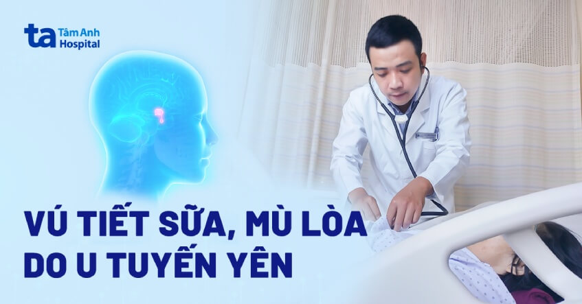 Vú tiết sữa mù lòa do u tuyến yên