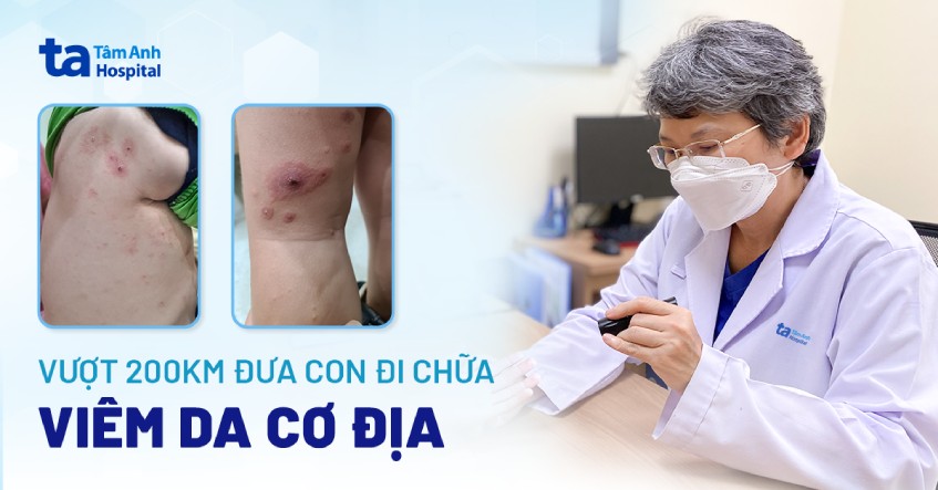 Vượt 200km đưa con đi chữa viêm da cơ địa