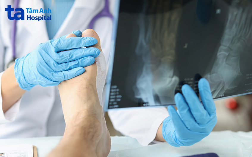 x quang giúp phát hiện tình trạng viêm của khớp