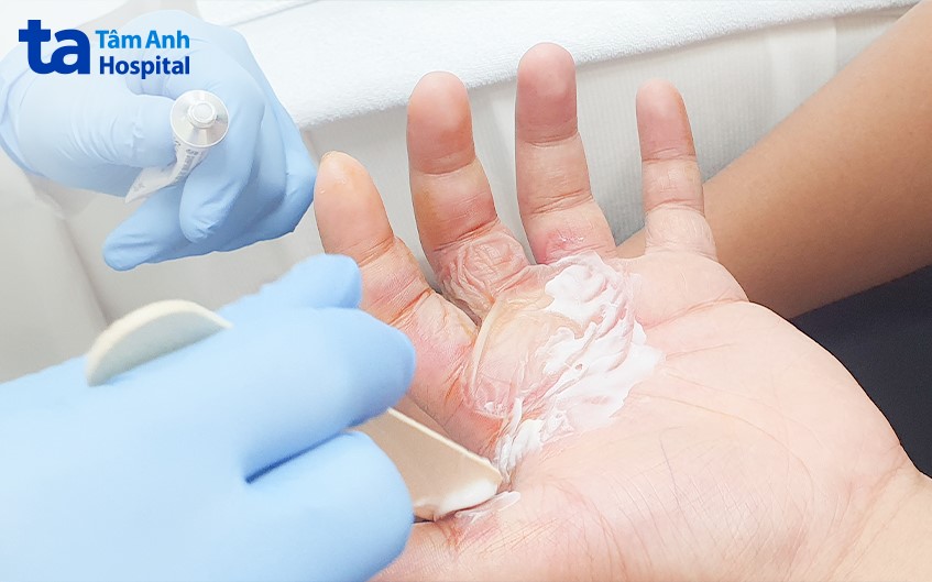 Bs bôi thuốc kháng sinh sau xử lý bóng nước