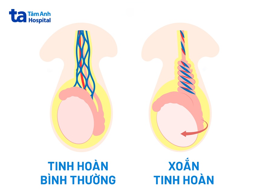 Xoắn tinh hoàn là dị tật bẩm sinh nguy cơ phải cắt bỏ tinh hoàn nếu không cấp cứu kịp thời